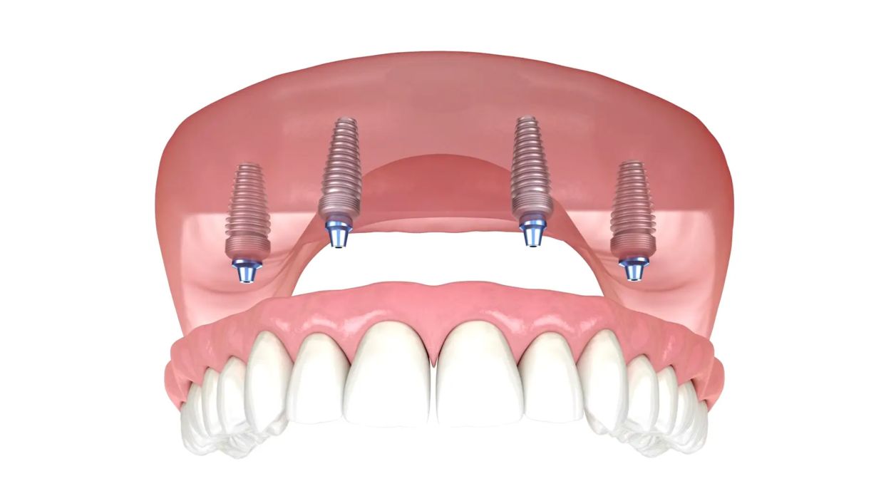 Implant retained dentured